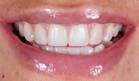 After - Ringway Dental
