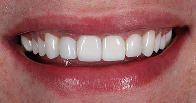 After - Ringway Dental