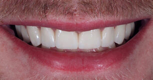 After - Ringway Dental