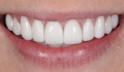 After - Ringway Dental