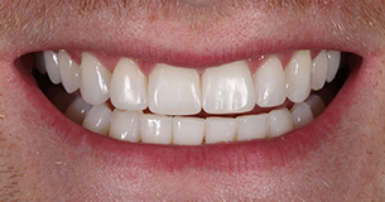 After - Ringway Dental