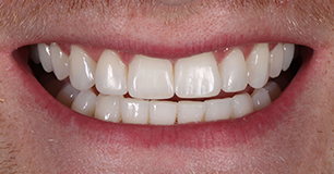 After - Ringway Dental