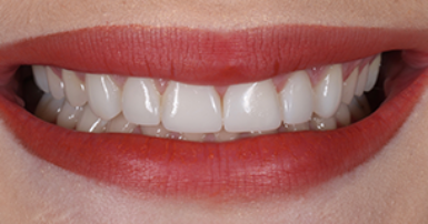 After - Ringway Dental