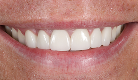 After - Ringway Dental