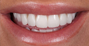 After - Ringway Dental