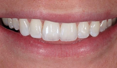 After - Ringway Dental