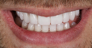 After - Ringway Dental