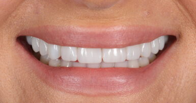 After - Ringway Dental