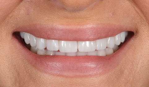After - Ringway Dental