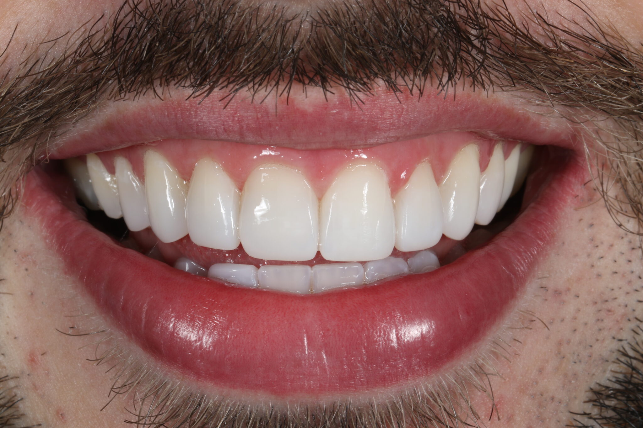 Composite Bonding Manchester Tooth Bonding in Manchester Ringway Dental