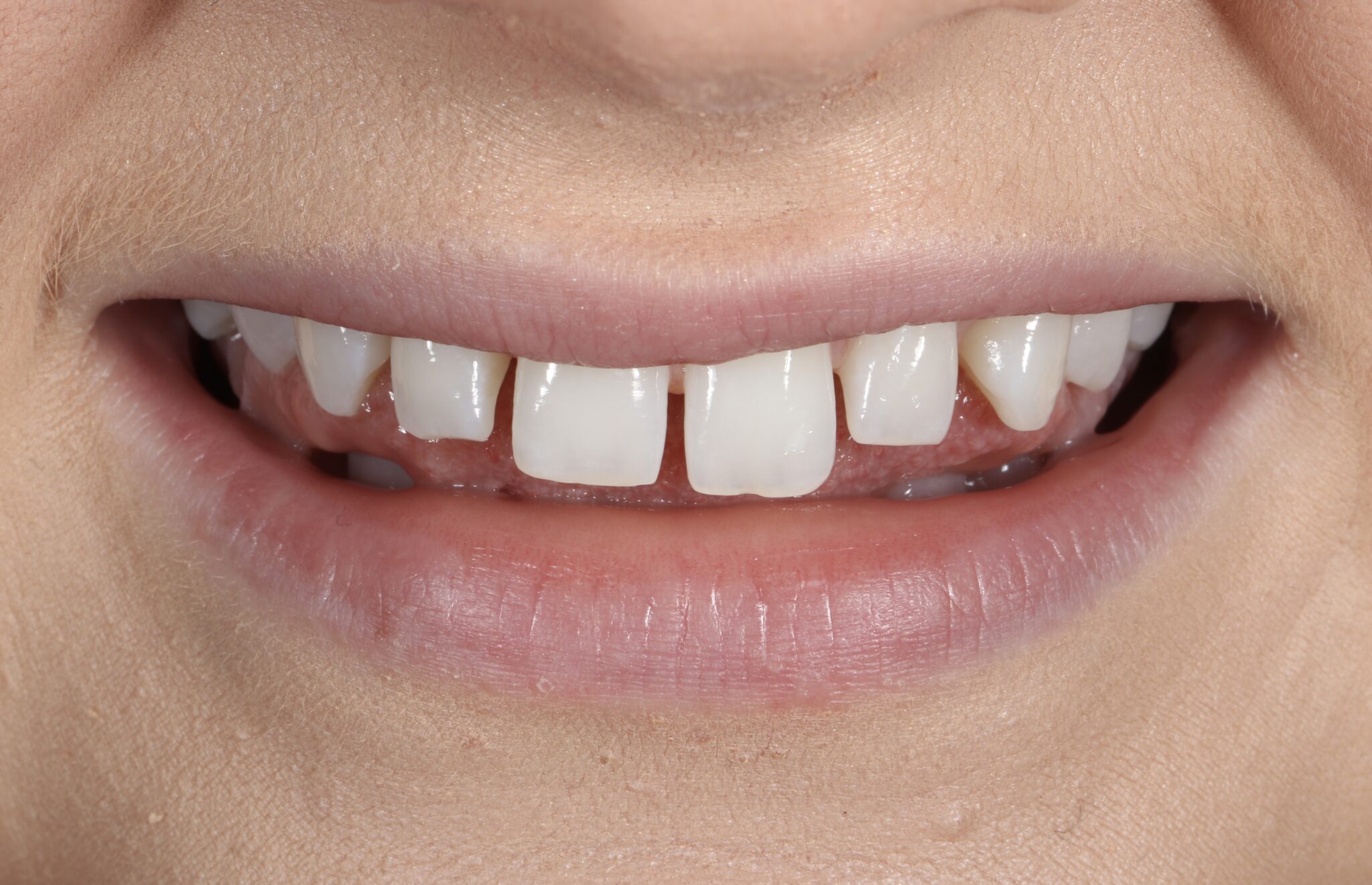 Composite Bonding Manchester Tooth Bonding in Manchester Ringway Dental