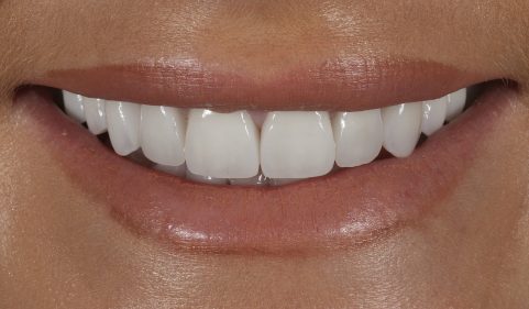 After - Ringway Dental