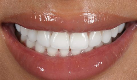 After - Ringway Dental