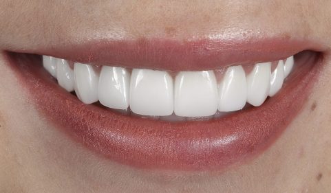 After - Ringway Dental