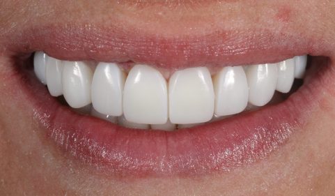 After - Ringway Dental