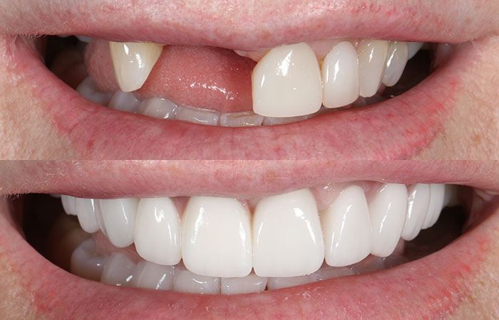 dental-implants-manchester