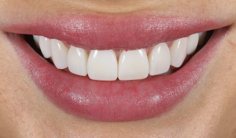 After - Ringway Dental