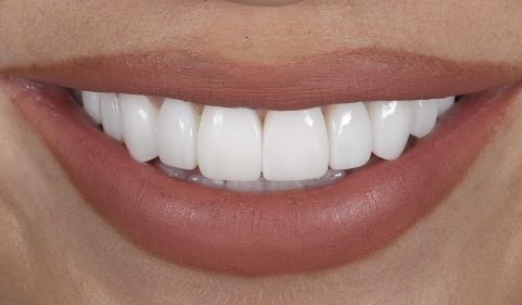 After - Ringway Dental