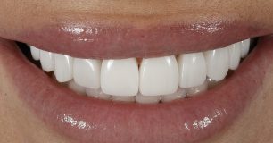 After - Ringway Dental