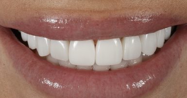 After - Ringway Dental